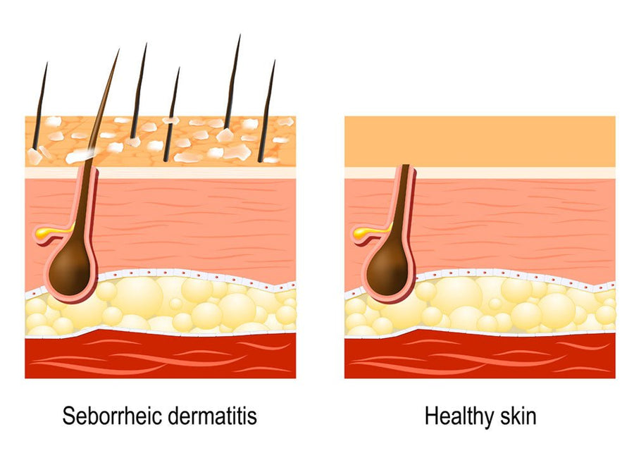 Does Shaving Your Head Cure Dandruff? - HeadBlade