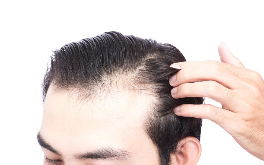 Genetics and Heredity of receding hairlines - HeadBlade